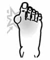 Illustration eines Fußes mit Hallux Valgus, bei dem der große Zeh schief steht und Schmerzen signalisiert.